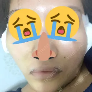 0日目の経過画像（2枚目）