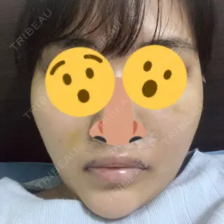 5日目の経過画像（1枚目）