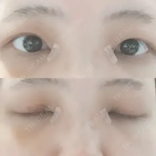 5日目の経過画像（1枚目）