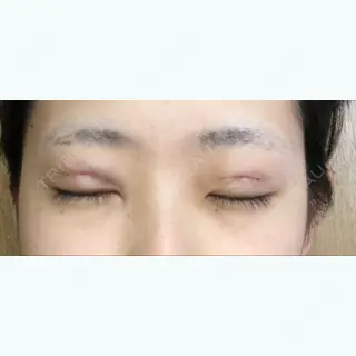 1日目の経過画像（3枚目）