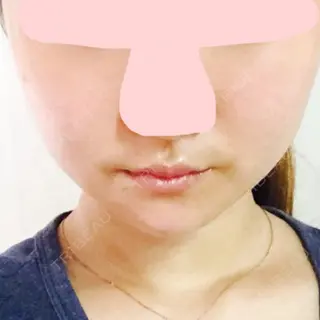 21日目の経過画像（1枚目）