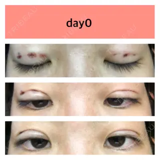 0日目の経過画像（1枚目）