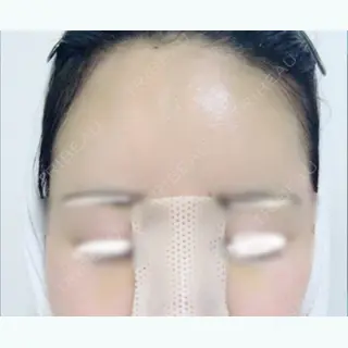 6日目の経過画像（2枚目）