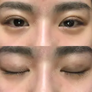 2日目の経過画像（1枚目）