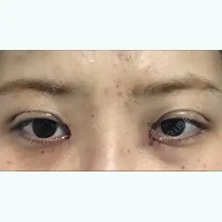 1日目の経過画像（2枚目）