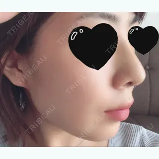 6日目の経過画像（1枚目）