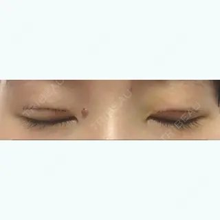 5日目の経過画像（3枚目）
