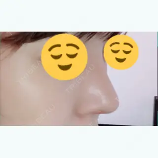 42日目の経過画像（1枚目）