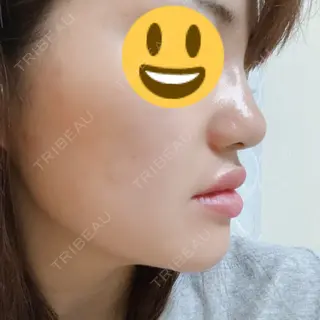 1日目の経過画像（2枚目）