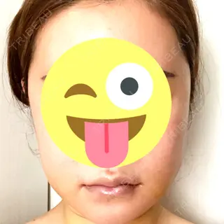 6日目の経過画像（1枚目）