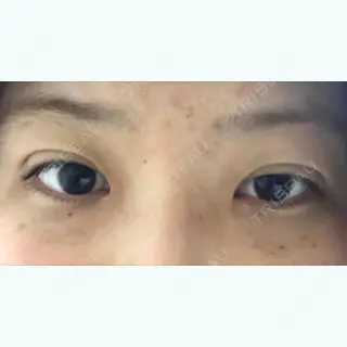 12日目の経過画像（1枚目）
