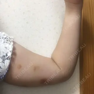 6日目の経過画像（2枚目）