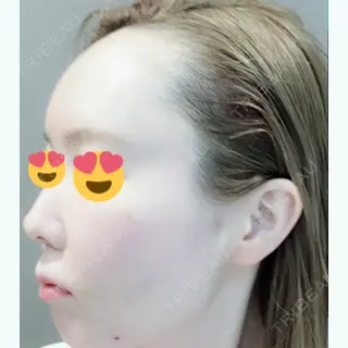 0日目の経過画像（2枚目）