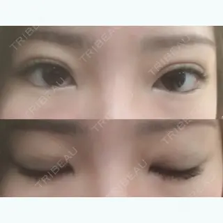 6日目の経過画像（1枚目）