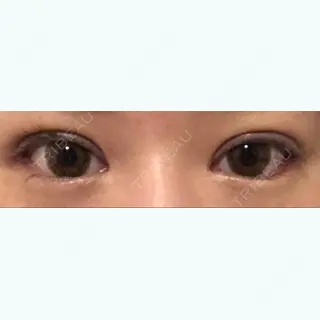 31日目の経過画像（1枚目）