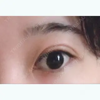 1日目の経過画像（3枚目）