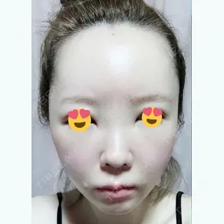 2日目の経過画像（1枚目）