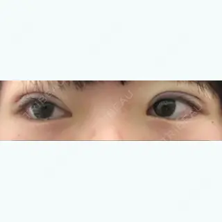 0日目の経過画像（1枚目）