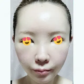 2日目の経過画像（1枚目）