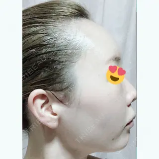2日目の経過画像（2枚目）