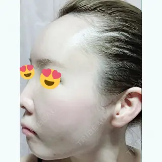 2日目の経過画像（3枚目）