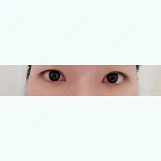 0日目の経過画像（1枚目）