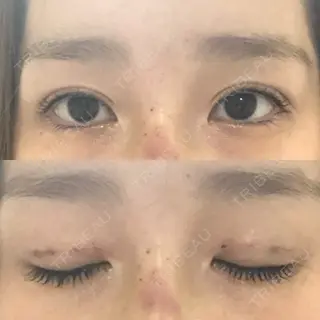 0日目の経過画像（1枚目）