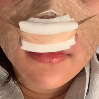 0日目の経過画像（2枚目）