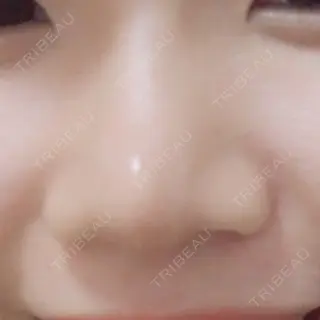 18日目の経過画像（1枚目）