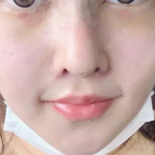 6日目の経過画像（2枚目）