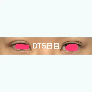 5日目の経過画像（1枚目）