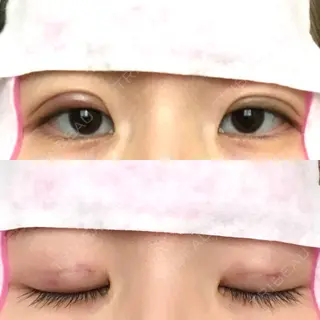 1日目の経過画像（1枚目）