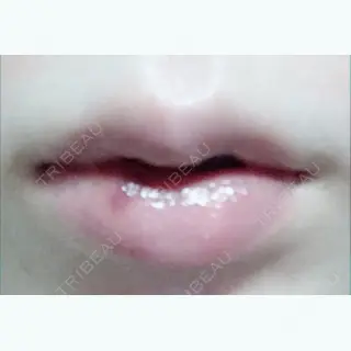 3日目の経過画像（1枚目）