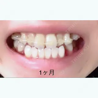 33日目の経過画像（1枚目）