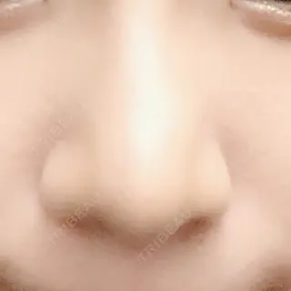99日目の経過画像（1枚目）