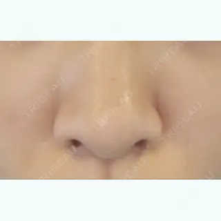 8日目の経過画像（1枚目）