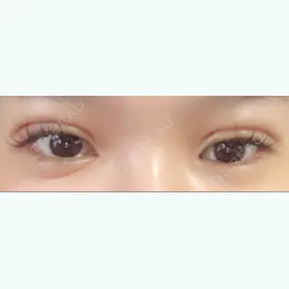 1日目の経過画像（1枚目）