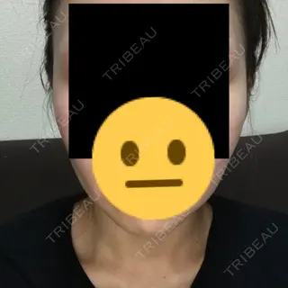 45日目の経過画像（1枚目）
