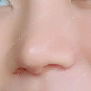 20日目の経過画像（1枚目）