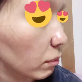 0日目の経過画像（2枚目）