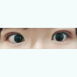 5日目の経過画像（1枚目）