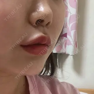 4日目の経過画像（2枚目）