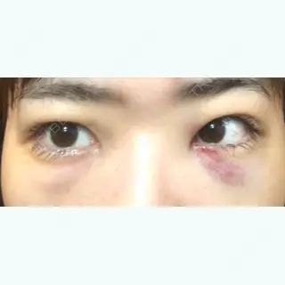 1日目の経過画像（1枚目）