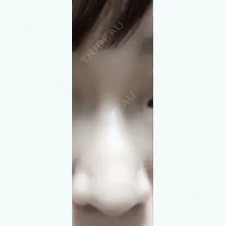 18日目の経過画像（1枚目）
