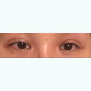 6日目の経過画像（1枚目）