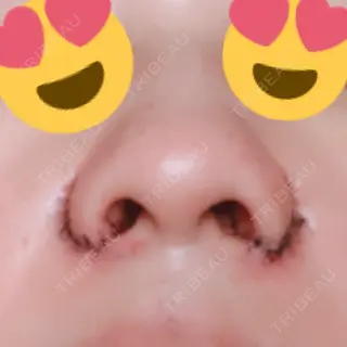 1日目の経過画像（3枚目）