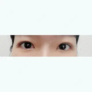 2日目の経過画像（1枚目）