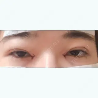 0日目の経過画像（1枚目）