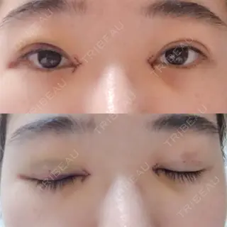3日目の経過画像（1枚目）