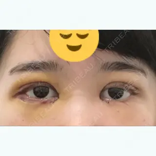3日目の経過画像（1枚目）